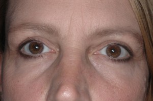 Female Eyelid Surgery