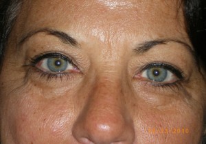 Female Eyelid Surgery