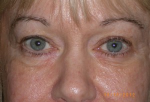 Female Eyelid Surgery