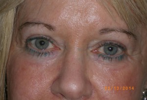 Female Eyelid Surgery