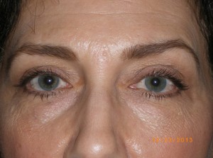 Female Eyelid Surgery