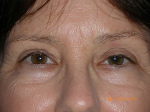 Female Eyelid Surgery