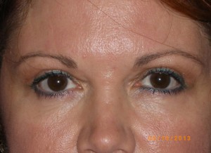 Female Eyelid Surgery