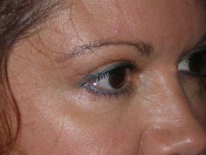 Female Eyelid Surgery