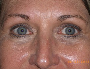 Female Eyelid Surgery